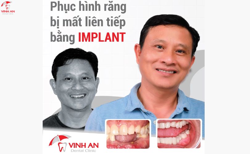Bộ Implant Kit