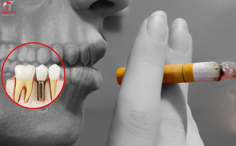 Có Thói Quen Hút Thuốc Lâu Ngày Thì Trồng Răng Implant Được Không?