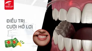 Dieu-tri-cuoi-ho-loi-an-toan (11)