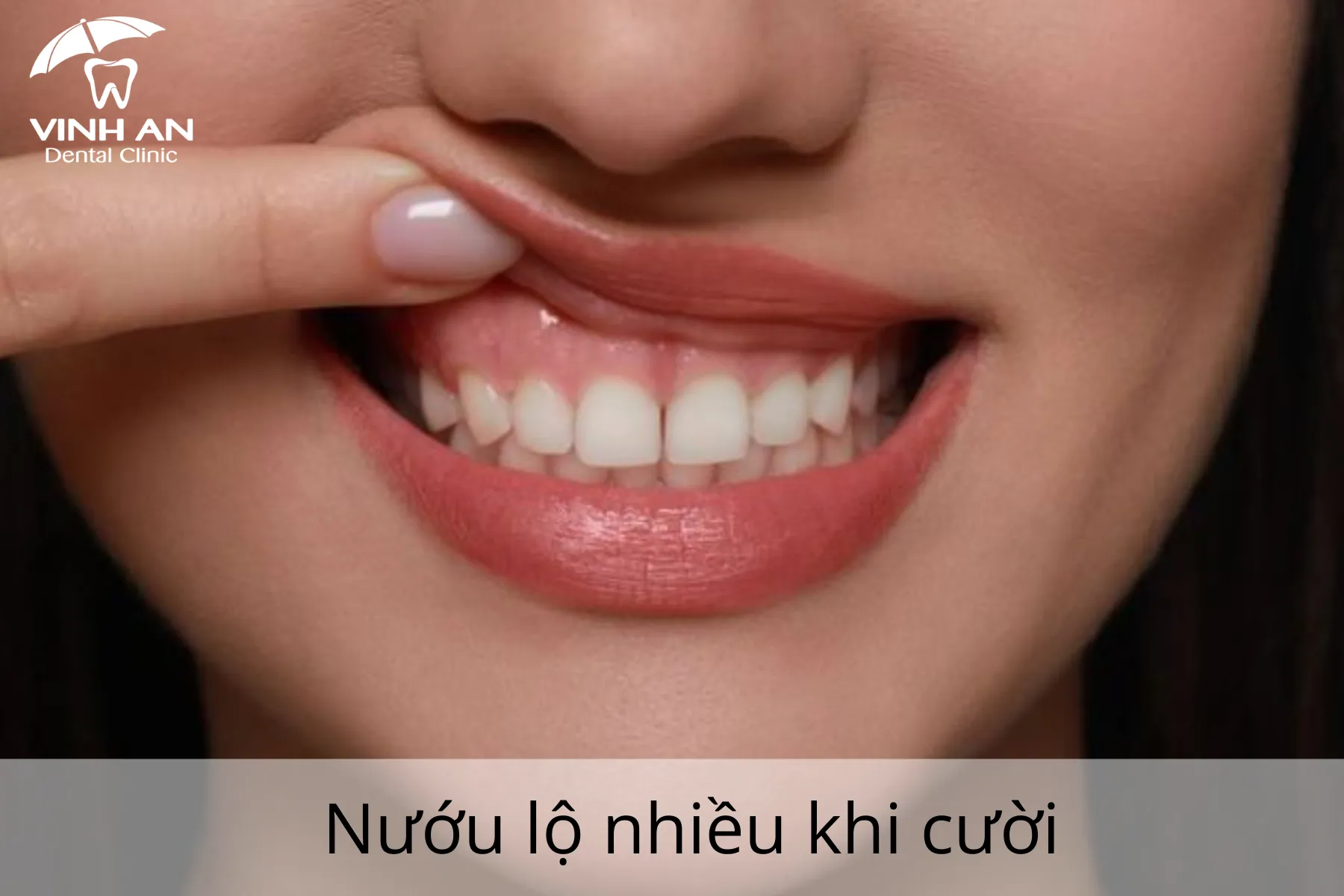 Dieu-tri-cuoi-ho-loi-an-toan (3)