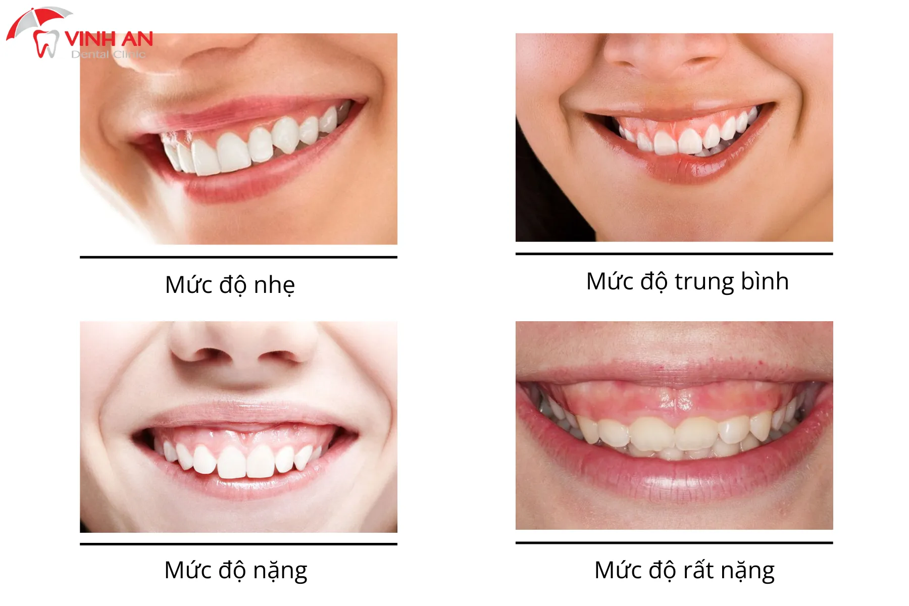 Dieu-tri-cuoi-ho-loi-an-toan (7)