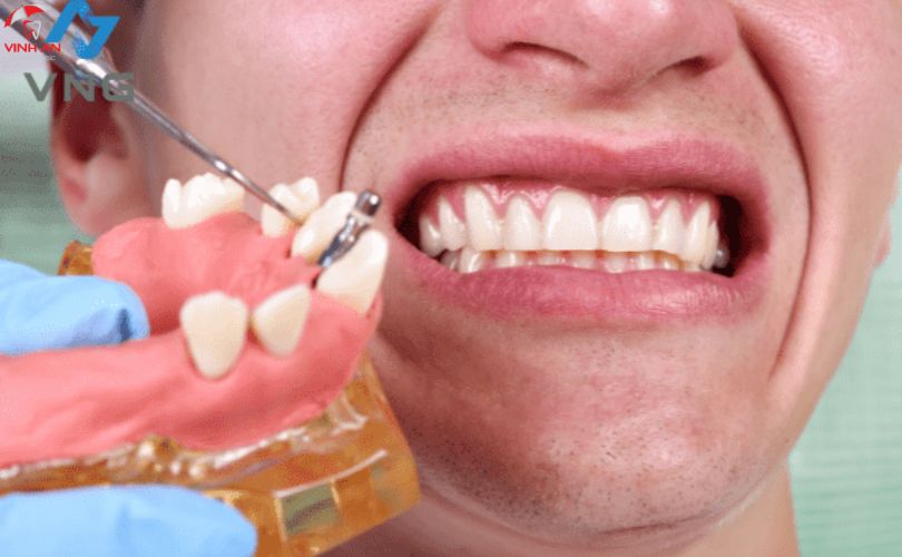 Giá Trồng Răng Implant Là Bao Nhiêu?