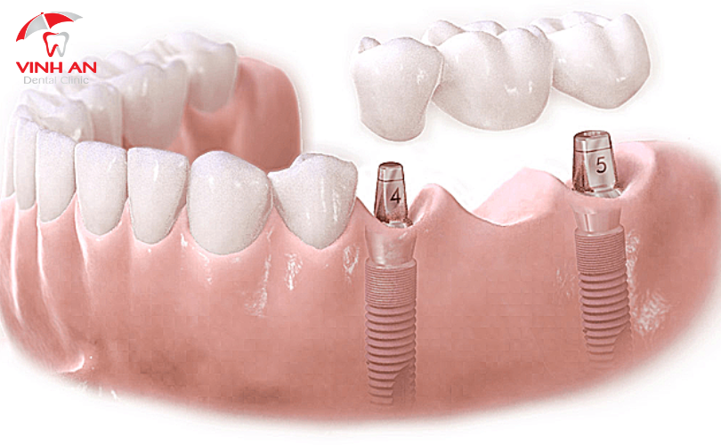 Implant Nâng đỡ Cầu Răng 