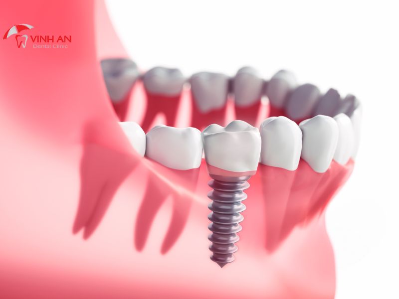 Implant thay thế 1 răng