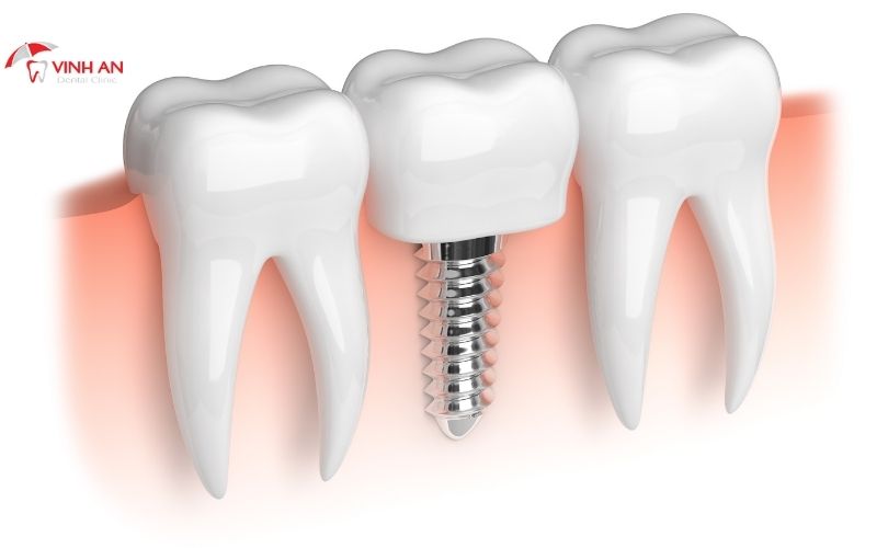 Implant thay thế 1 răng