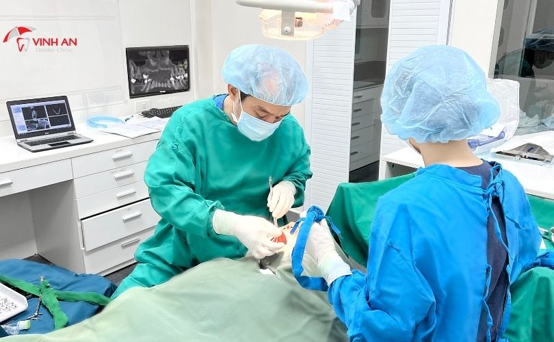 Implant thay thế 1 răng