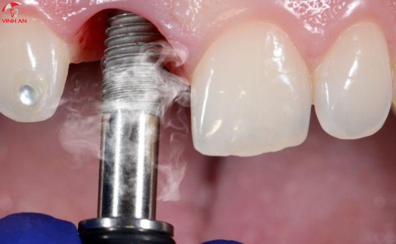 Mối Quan Hệ Giữa Trồng Răng Implant Và Thuốc Lá Là Gì?