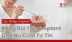 Rang-gia-tren-implant