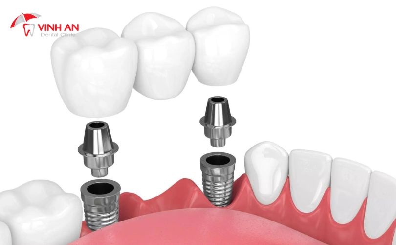 Răng Giả Trên Implant2