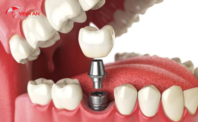 Răng Giả Trên Implant3
