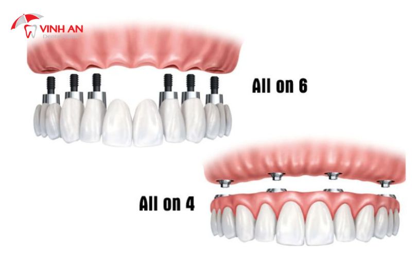 Răng Giả Trên Implant4