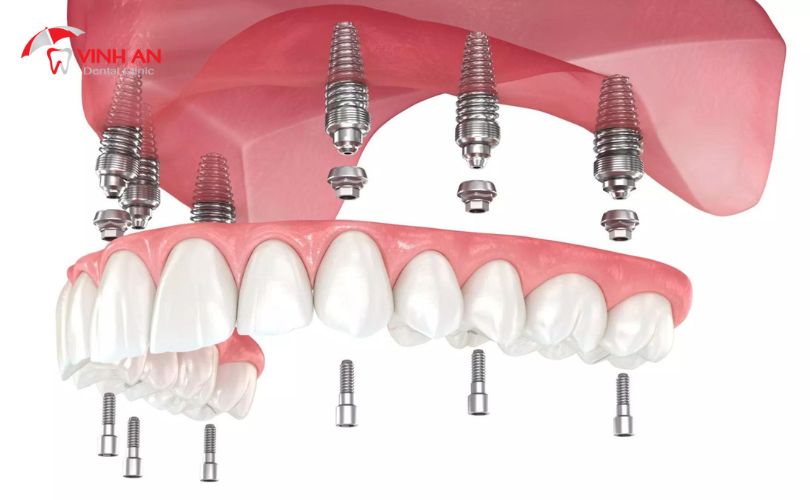 Răng Giả Trên Implant5