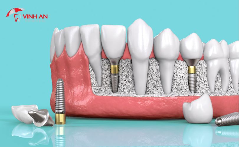 Răng Giả Trên Implant9