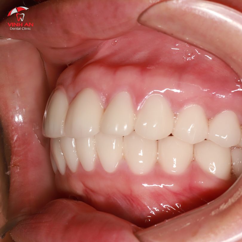 Trồng răng Implant all on 6