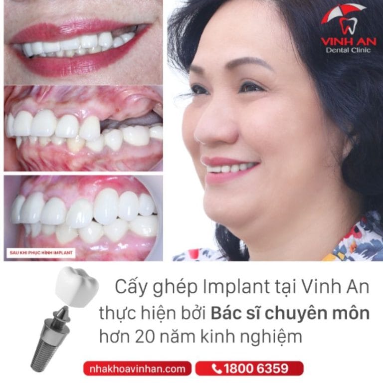 Trụ Implant Nobel Biocare - Xuất xứ, Ưu Điểm Và Gía Cả