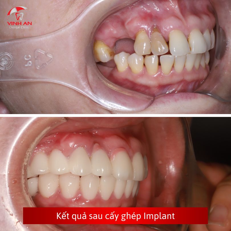 Trồng răng Implant All on 4