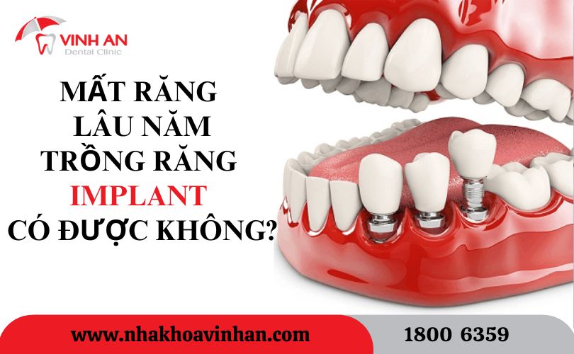 Hối Hận Khi Trồng Implant7.