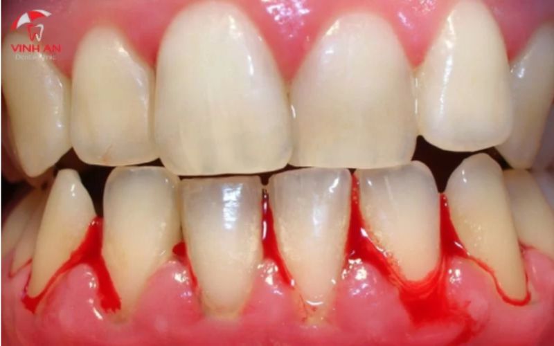 Trồng răng Implant để hạn chế tình trạng răng bị viêm nha chu