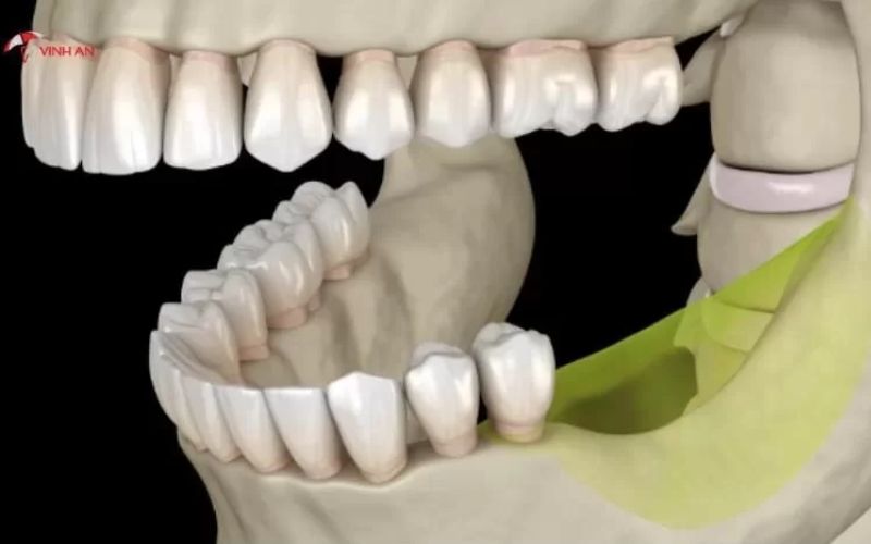 Trường hợp mất răng lâu ngày nên trồng răng Implant càng sớm càng tốt