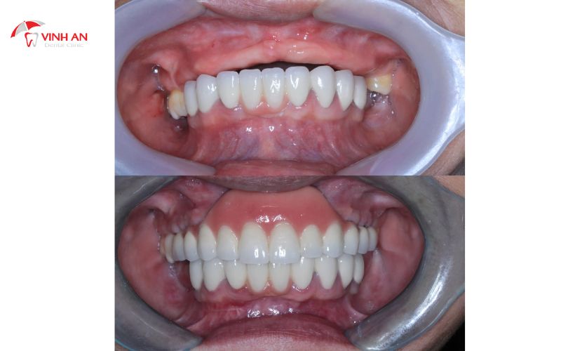Khi mất nhiều răng ở các vị trí gần nhau thì nên sử dụng phương pháp trồng răng Implant