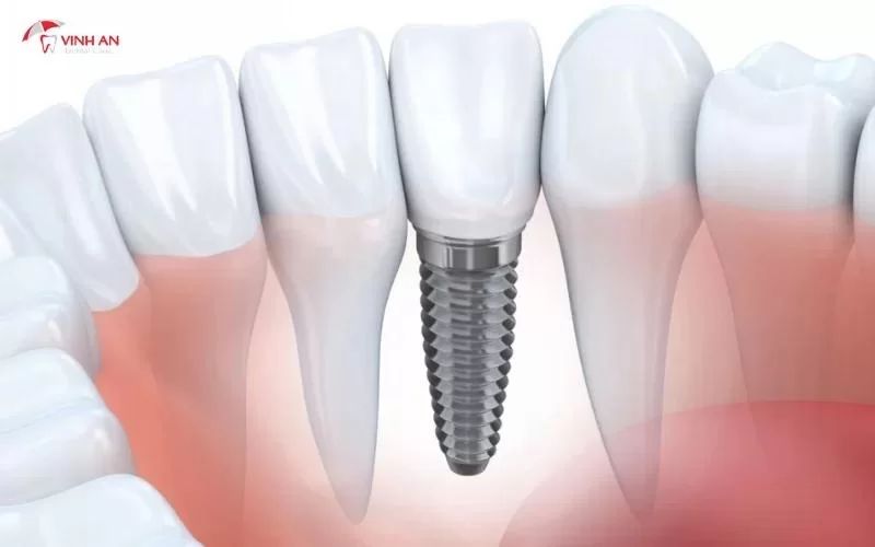 Trường hợp mất răng toàn hàm chắc chắn phải cấy ghép Implant