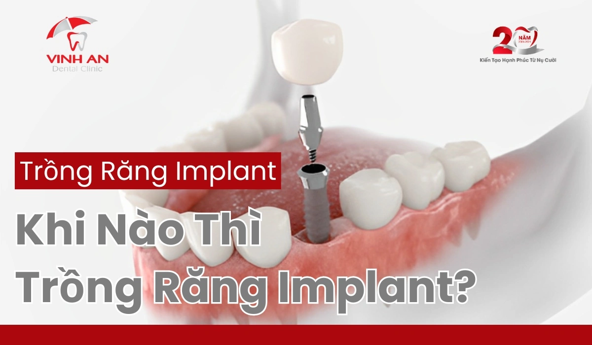Khi-nao-thi-trong-rang-implant-la-tot-nhat?