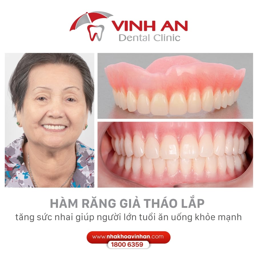 Hàm giả tháo lắp