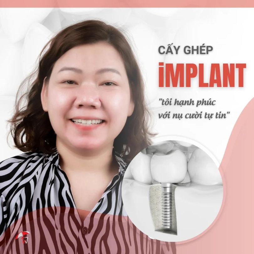 Hình ảnh và review thực tế khách hàng đã cấy ghép Implant tại trung tâm Implant chuyên sâu Vinh An