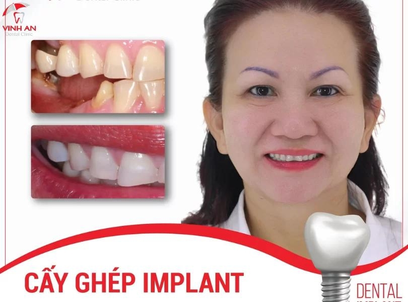 Hình ảnh của khách hàng trước và sau khi trồng răng Implant tại trung tâm Implant chuyên sâu Vinh An