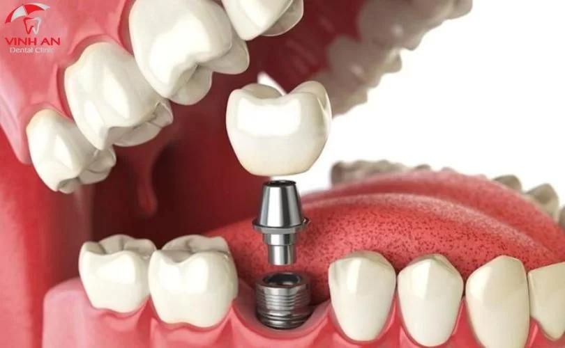 trồng răng Implant ở phòng mổ áp lực dương
