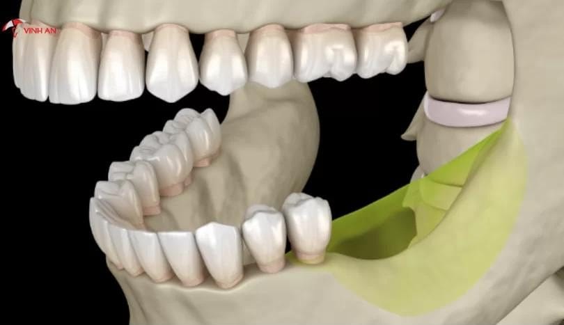 Trường hợp mất răng lâu ngày nên trồng răng Implant càng sớm càng tốt