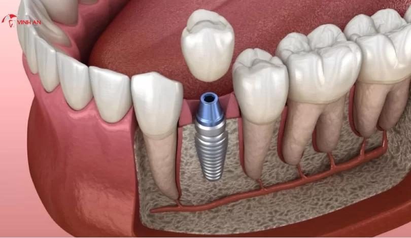 Trường hợp chống chỉ định với trồng răng Implant
