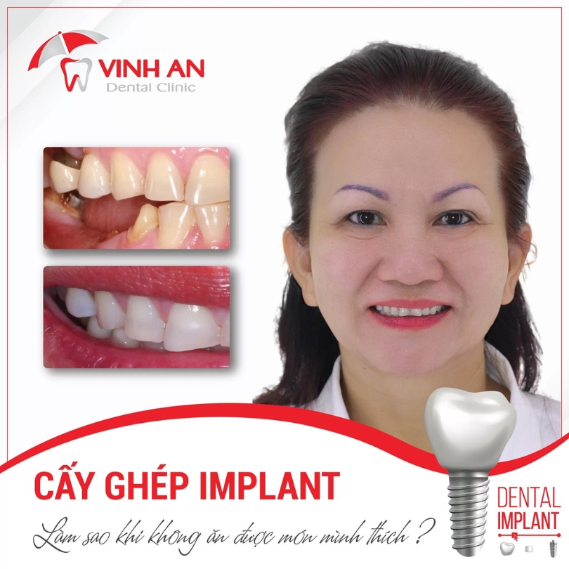 Hình ảnh thực tế của khách hàng đã cấy ghép Implant tại trung tâm Implant chuyên sâu Vinh An