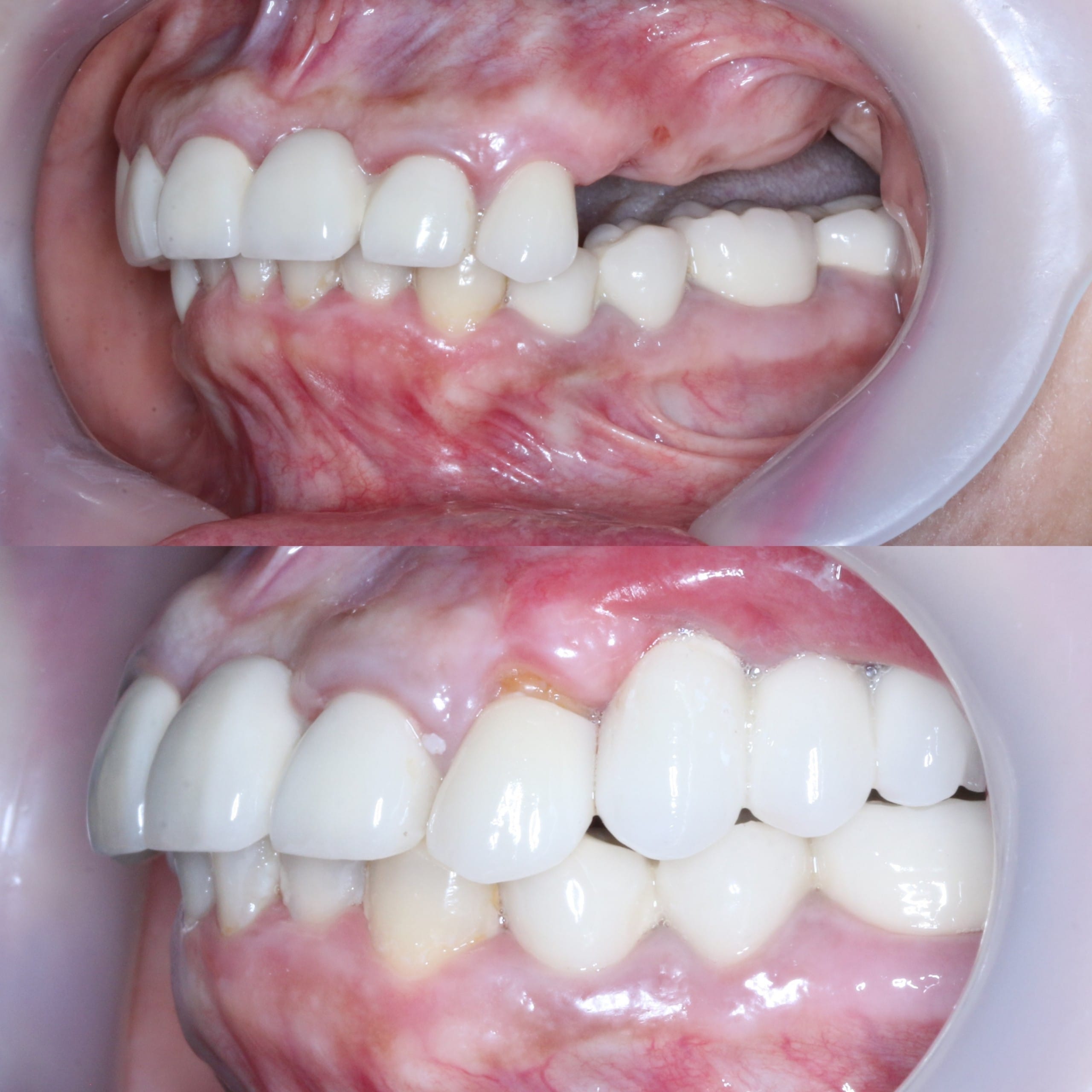Trồng răng Implant để hạn chế tình trạng răng bị viêm nha chu
