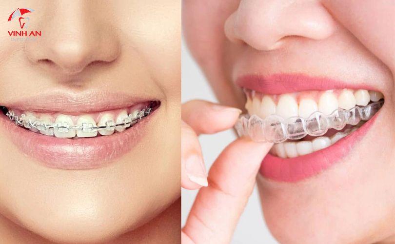Việc niềng răng sai kỹ thuật có thể gây ra nhiều tác hại