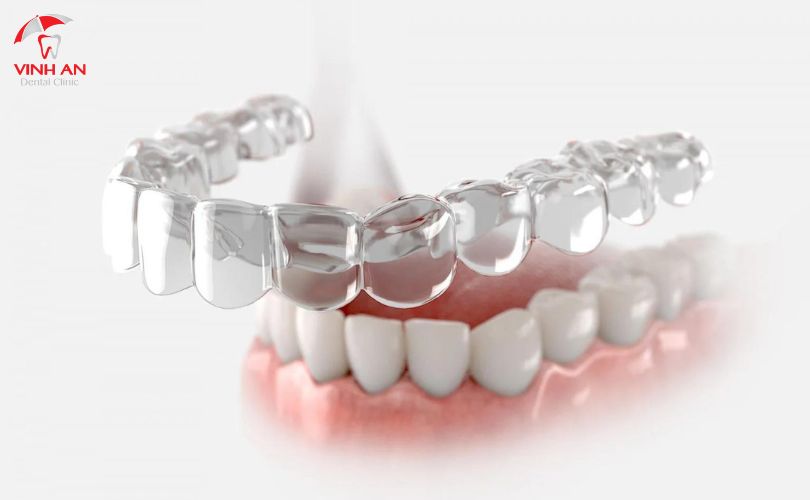  Chỉnh nha là phương pháp điều chỉnh hình dáng răng và cải thiện sức khỏe răng miệng.
