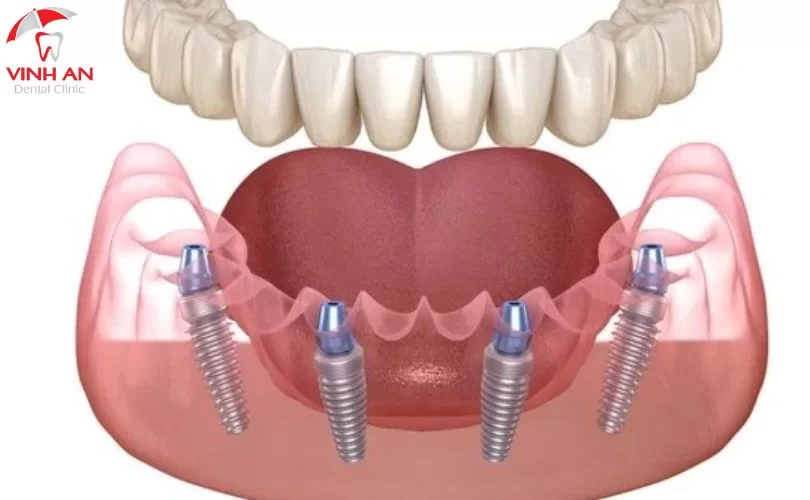 Implant All On 4