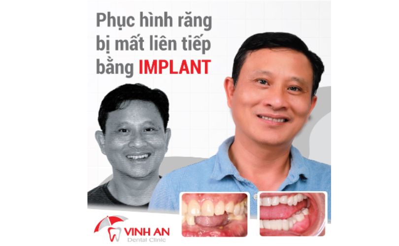 Cắm Răng Implant Bị Xô Lệch 2