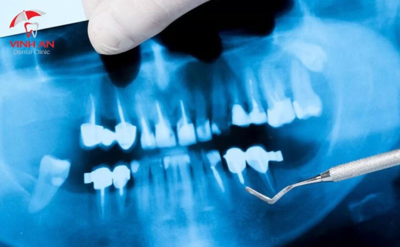 Quy Trình Phẫu Thuật Cấy Ghép Xương Răng