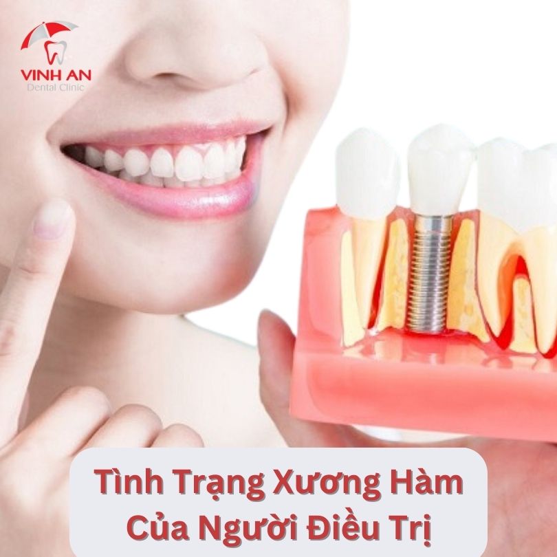 Tuổi Thọ Răng Implant