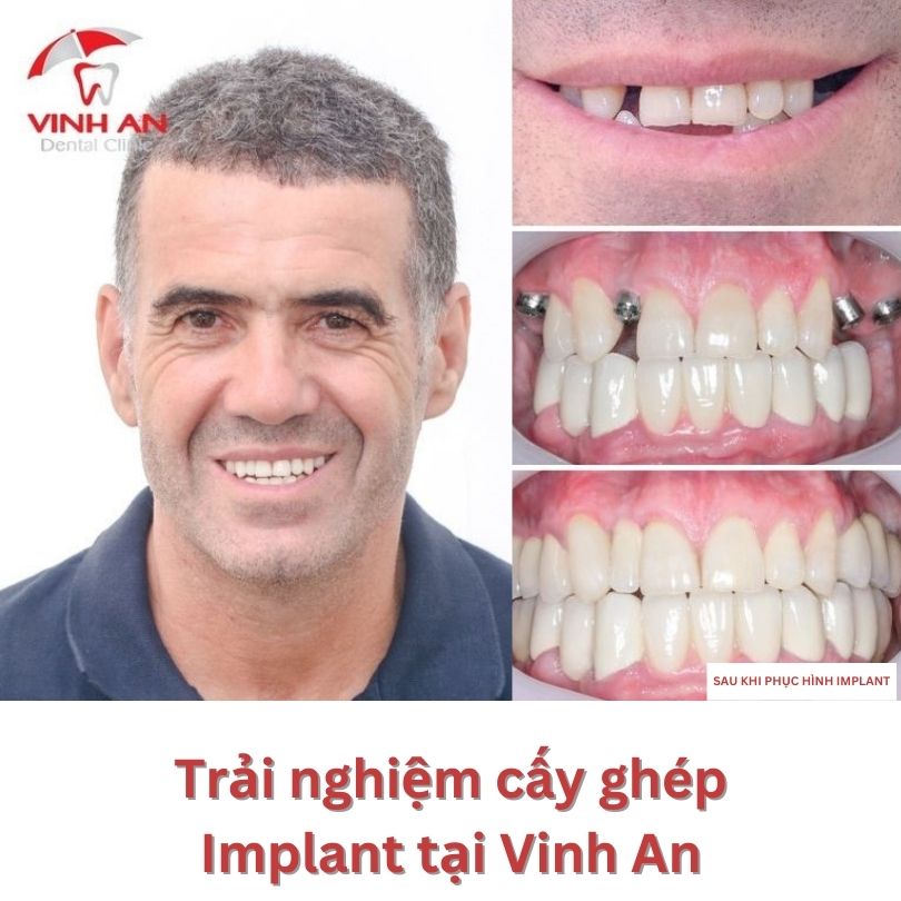 Tuổi Thọ Răng Implant 