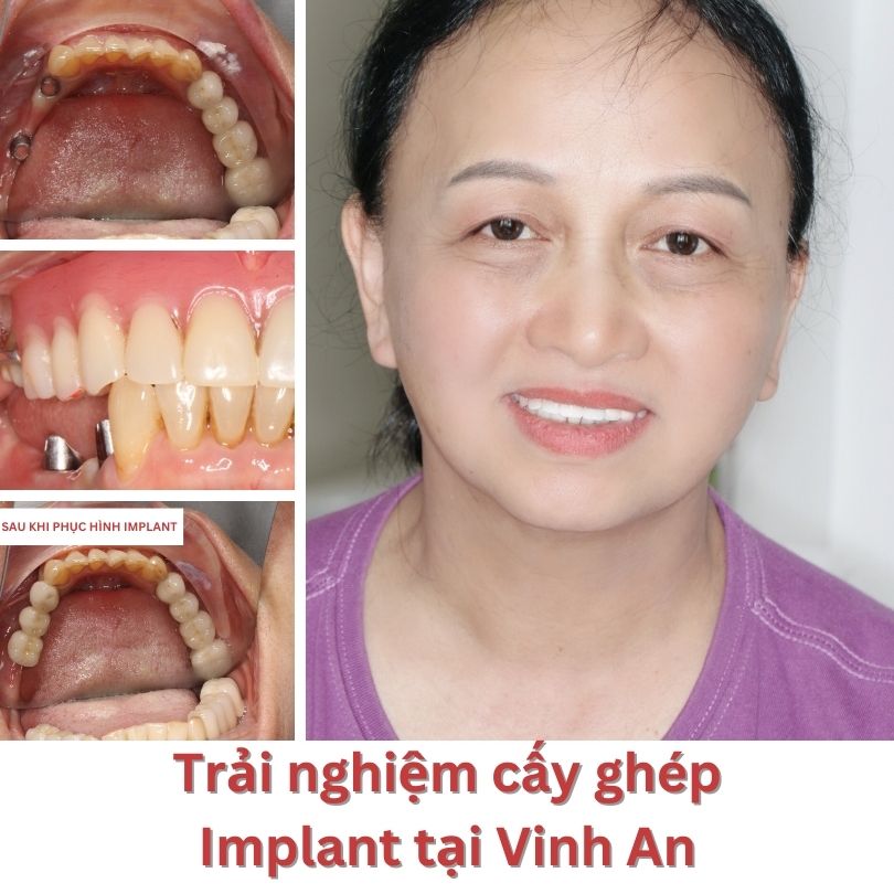 Tuổi Thọ Răng Implant 