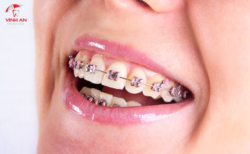 Hàm răng có ảnh hưởng nhiều đến khuôn mặt