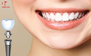 trồng răng implant có chụp mri được không