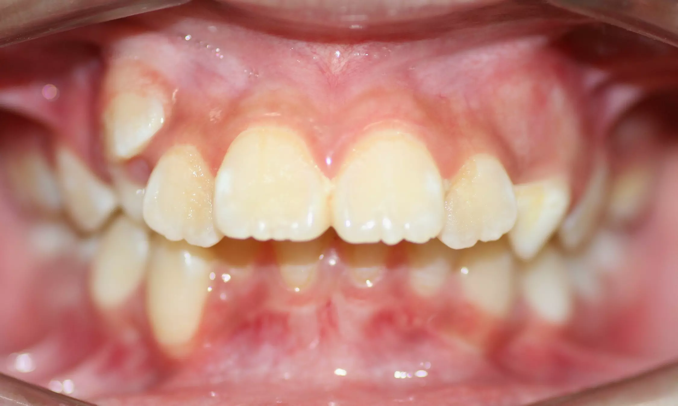 niềng răng thay đổi diện mạo