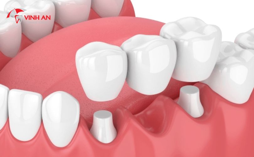 Trồng Răng Hàm Implant5