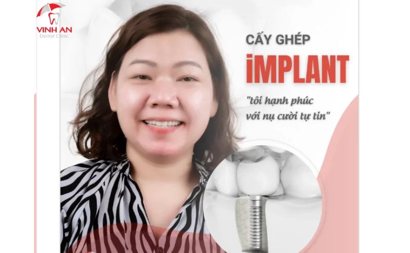 Hình Ảnh Và Review Thực Tế Khách Hàng Đã Trồng Răng Implant Tại Trung Tâm Implant Chuyên Sâu Vinh An
