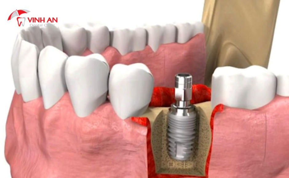 Tác Hại Của Việc Trồng Răng Implant 