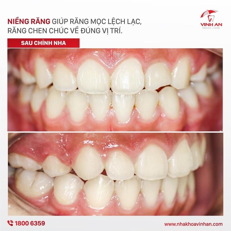 các giai đoạn niềng răng