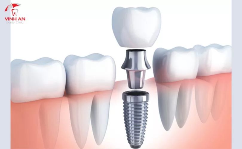 Răng Tạm Trên Implant 7